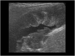 Malignant mesothelioma is an aggressive tumour originating in the serosal membranes that line the thoracic and abdominal cavities. Pin On Pleural Ultrasound