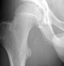 Image result for Hip Apophysitis