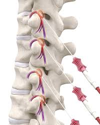 Image result for Radiofrequency Surgery