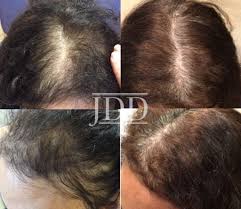 It was noticed that patients being treated with minoxidil developed excessive hair growth. A Closer Look At A Multi Targeted Approach To Hair Loss In African American Women Next Steps In Dermatology