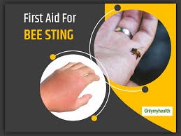 Call emergency medical services if you have a history of severe reactions to insect stings or if you experience any severe symptoms as described above. World First Aid Day 2020 First Aid Solutions For A Bee Sting