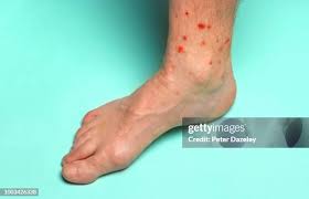 Image result for Trombicula autumnalis