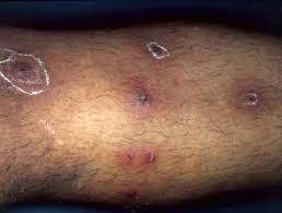 Others boil, such as those of acne, are caused by plugged sweat glands that become infected. Boil Dermnet Nz