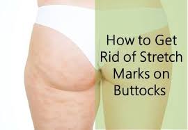Rub in the juices to the affected area and let it dry for about 10 minutes before rinsing off. 6 Ways To Get Rid Of Stretch Marks On Buttocks