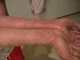 It's also called atopic dermatitis. Disorders Of Skin Biology For Majors Ii