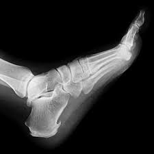 Image result for Calcaneus Compression Fracture