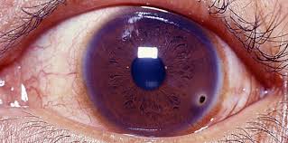 Image result for Eye Foreign Body