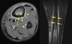 Image result for Tibia Stress Fracture