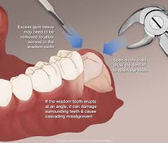 A wisdom tooth extraction cost ranges from $160 to $489 depending on how impacted your wisdom tooth is. Wisdom Teeth Removal Scottsdale Az Phoenix Az Dental Works
