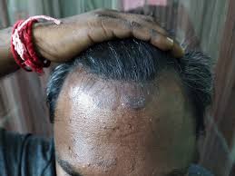 If scaling plaques are present on portions of the body in. Aren T You Worried About Scalp Psoriasis