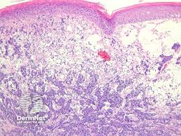 Image result for Merkel Cell Carcinoma