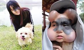 WHAT IS A GIANT CONGENITAL MELANOCYTIC NEVUS?