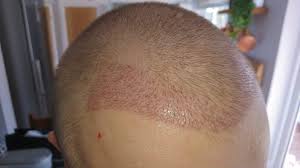 It operates in html5 canvas, so your images are created instantly on your own device. Fue Post Op Pictures Week 2 Hair Transplant Story