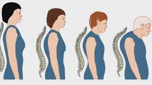 The medical name of this condition is dorsocervical fat pad. Hump On Back Of Neck Correct Bad Posture With Simple Steps