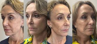 Gallery of Procedures