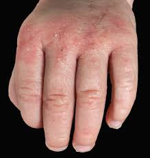 Diagnosis And Treatment Of Eczema In Children Prescriberprescriber