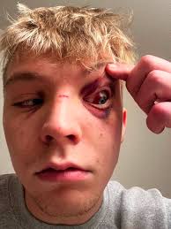 Attorney representing student allegedly punched by UI football player calls  for action