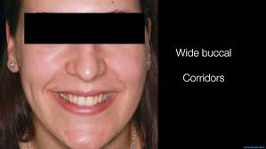 ⭐ MARPE-BAME: Expansión palatina rápida