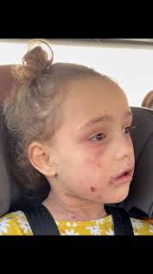 My baby girl is struggling so bad with her chronic illness these days, all  I can think about is @mikayla off @secretlivesonhulu skin, my baby girl has  an appointment soon to redo a plan for her skin ...