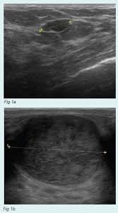Breast cancer is among the most common causes of cancer deaths today, coming fifth after lung, stomach, liver and colon cancers. Fibroadenoma Of The Breast Fact Sheet Westmead Bci