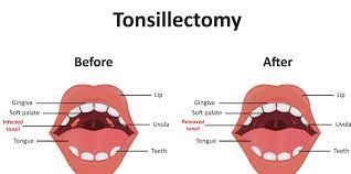 I'm getting my tonsils removed this friday, and am pretty nervous about it. Tonsillectomy Tonsil Removal For Singers Chicago Voice Care
