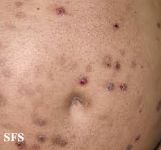 Image result for Neurotic Excoriation