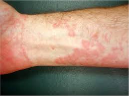 Image result for Erythema Multiforme Major