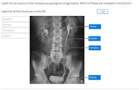 Image result for Intravenous Pyelogram