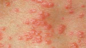 Concerned about a rash that's appeared on your baby's skin? Is It Herpes Or Something Else Everyday Health