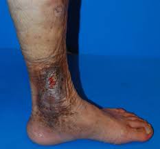 Image result for Stasis Dermatitis