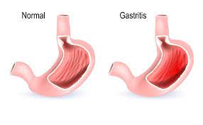 Magenschleimhautentzundung Symptome Behandlung Von Gastritis