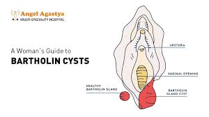 Image result for Bartholin's gland abscess