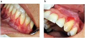 Image result for granuloma gum disease