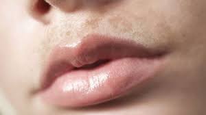 Your dermatologist can write a prescription for a higher strength hydroquinone product to help fade darkening above your upper lip. How To Lighten Dark Upper Lip 10 Home Remedies For Better Results