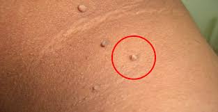 皮膚贅瘤 skin tags 又叫做 表皮肉垂 是常見於脖子 腋下 腹股溝等處的小肉球 它們可能皮下脂肪的累積 也可能是表皮擦傷所留下的結果 雖然表皮肉垂對人體健康並沒有特別傷害 但如果出現紅腫也