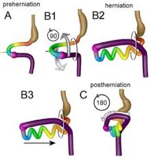 Image result for Intestinal Malrotation
