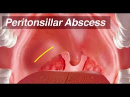 Image result for Peritonsillar Abscess