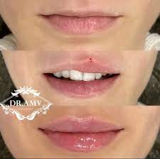 Pin By Ashley Flees On Lips Nose Botox Lips Facial Fillers Dermal Fillers Lips