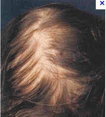 Recurrent mouth canker sores/oral ulcers (aphthous stomatitis) recurrent mouth canker sores/oral ulcers (sores on the inner side of the lips and cheeks) are a common condition of celiac disease. Alopecia Diffuse Balding Hair Loss Gluten Free Works Treatment Guide
