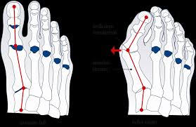 Wann ist eine hallux rigidus op gerechtfertigt? Gesunde Fusse Nicht Nur Eine Frage Der Asthetik Ortho Sport