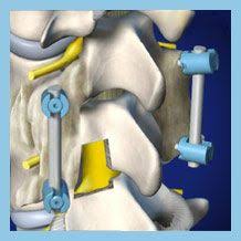 Minimally Invasive Tlif Spine Surgery Spondylolithesis Spinal Fusion