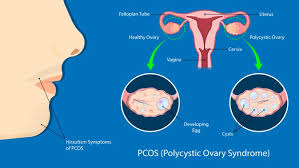 Apa Penyebab Pcos Dan Bagaimana Cara Mengatasi Pcos