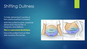 Image result for Shifting Dullness Test