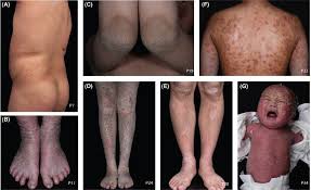Image result for Ichthyosis