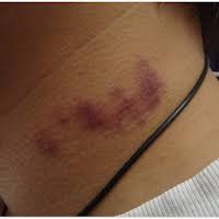 Cara untuk hilangkan hanya perlu. Tips Cara Untuk Hilangkan Kesan Love Bite Pada Leher