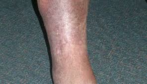 Image result for Lipodermatosclerosis