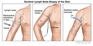 Melanoma is a type of skin cancer that develops in the skin cells (melanocytes) responsible for producing the pigment that gives your skin color (melanin). How We Treat Melanoma Dana Farber Cancer Institute Boston Ma