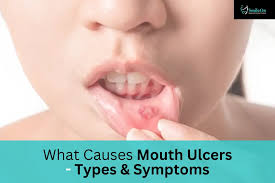 Image result for mouth ulcer on tongue)