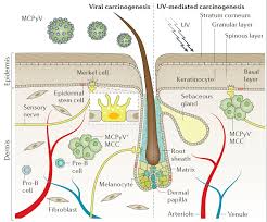 Image result for Merkel Cell Carcinoma