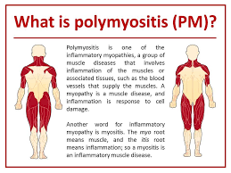 What Is Polymyositis Polymyositis Polymyalgia Rheumatica Symptoms Polymyalgia Rheumatica